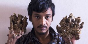 L' uomo albero del Bangladesh si sottoporrà a nuove operazioni