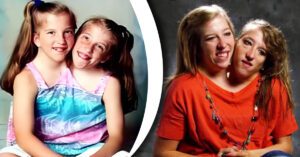 Abby e Brittany Hensel Gemelle siamesi si sposano, una storia unica di resilienza e celebrità. ed ora pensano ad un figlio