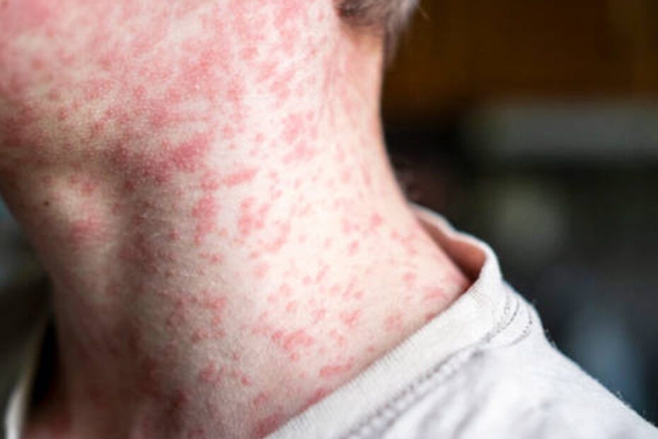Epidemia di morbillo: il CDC è in crisi tra fondi tagliati e casi in crescita. A rischio lo status di paese libero dal morbillo.